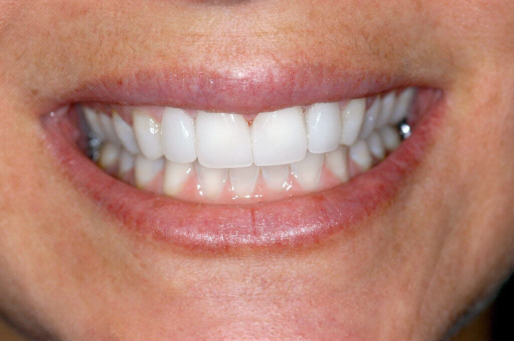 Before and After Porcelain Veneers Photos